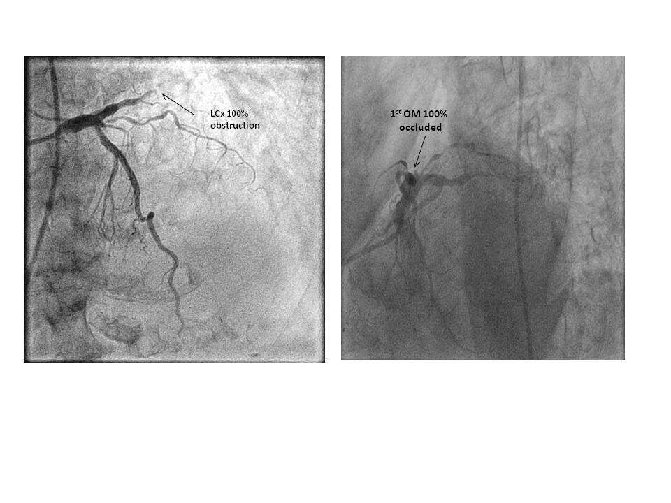 Double coronary artery thrombosis